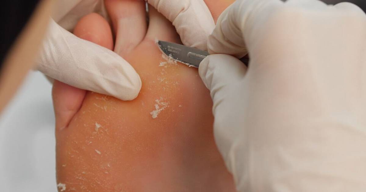 Corn Treatment On Feet
