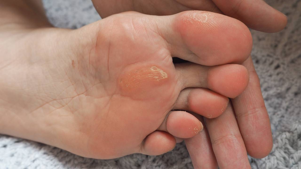 Foot Callus