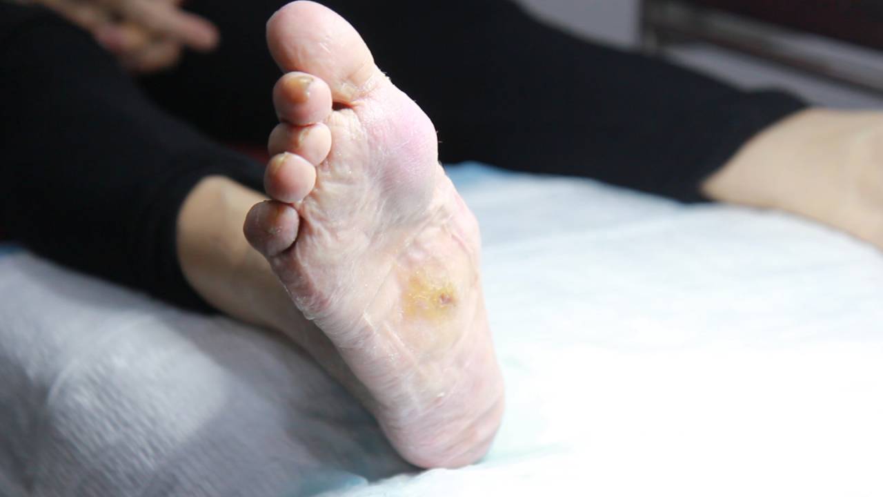 Charcot Foot Ulcer