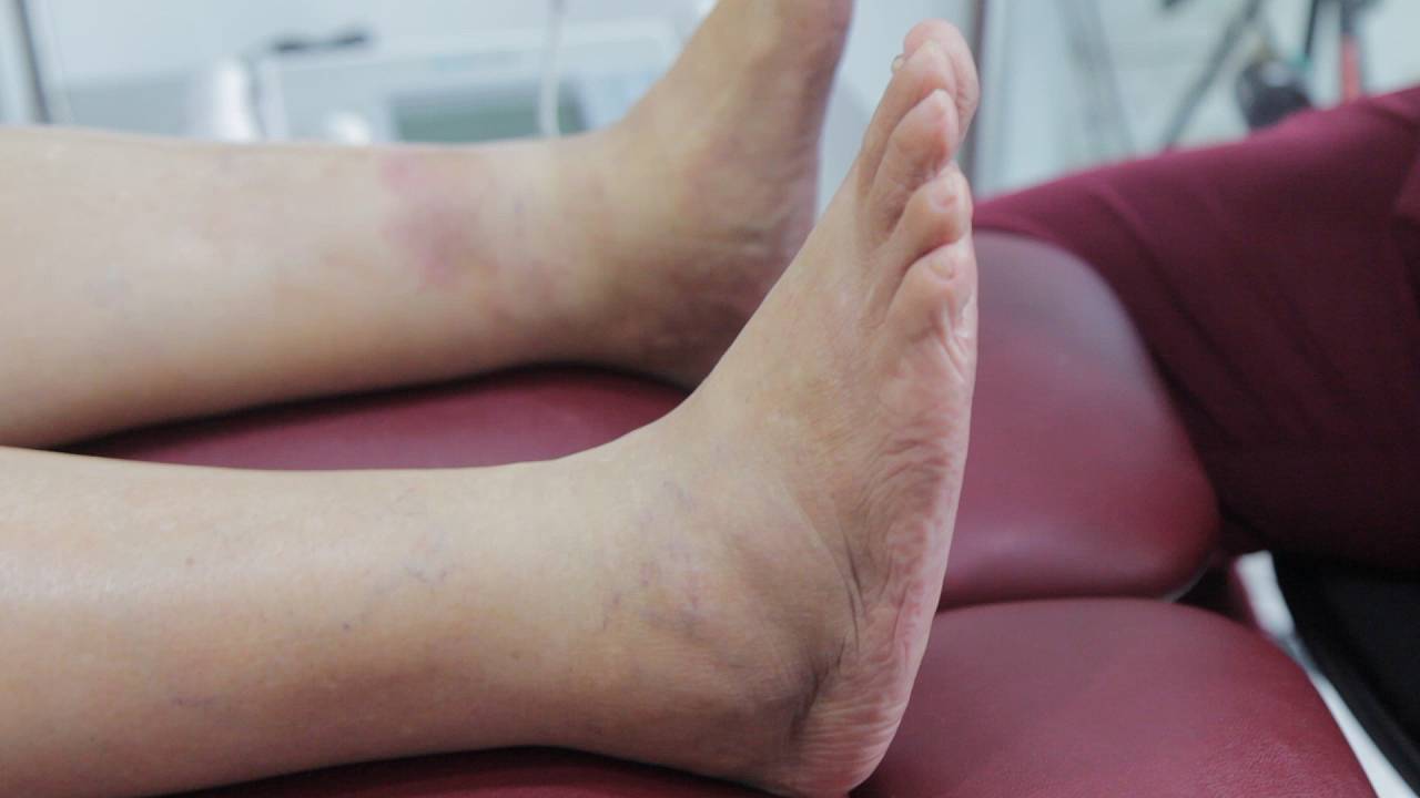 Charcot Foot