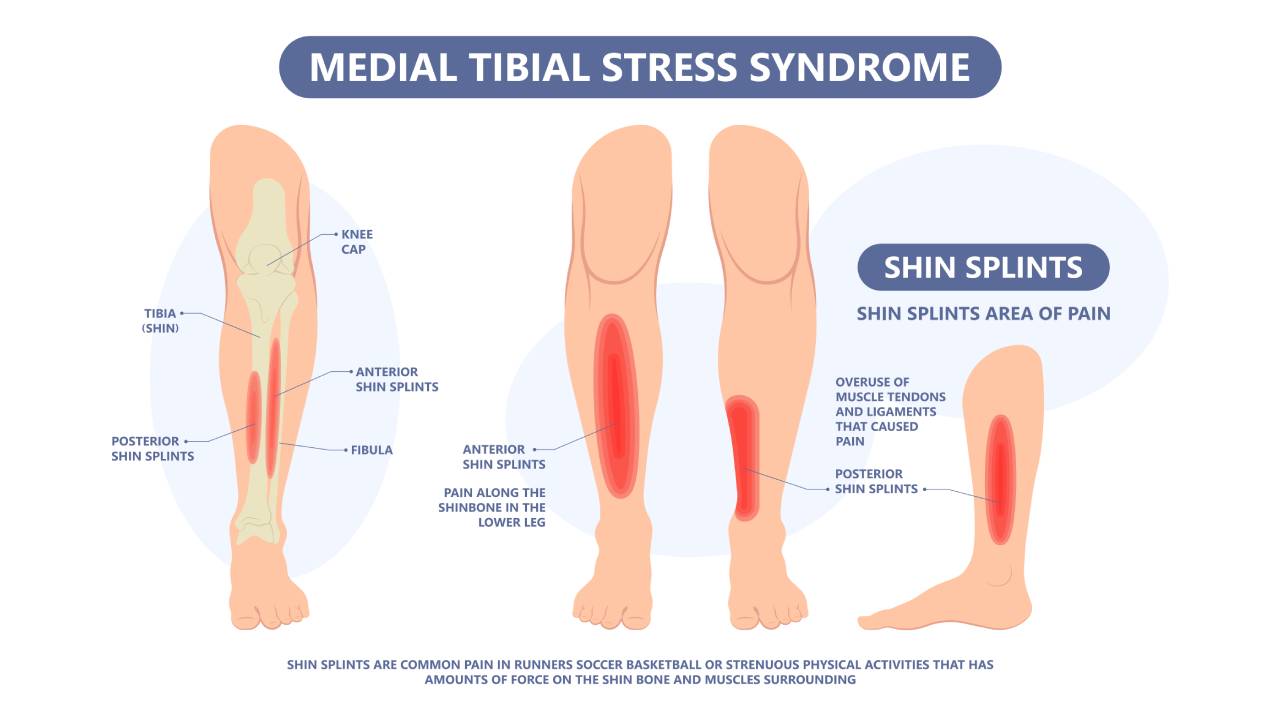Shin Splints Causes