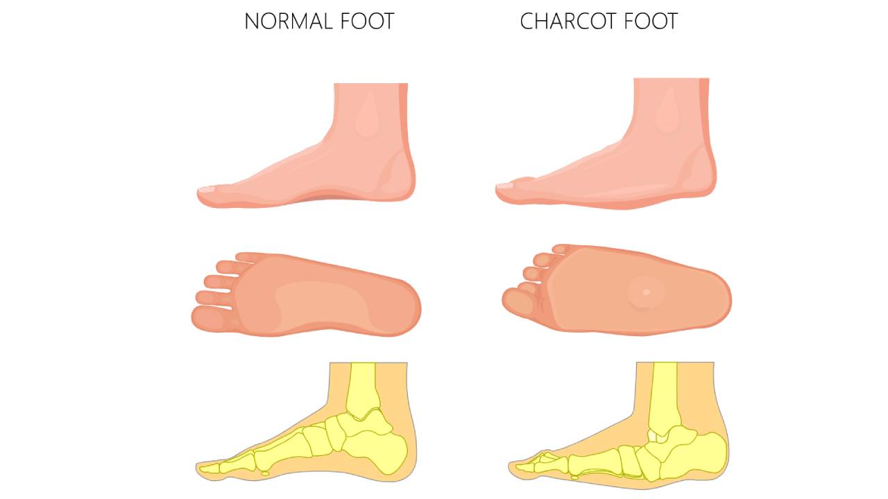 What is Charcot Foot