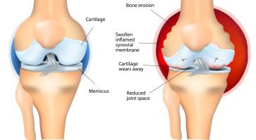 rheumatoid-arthritis